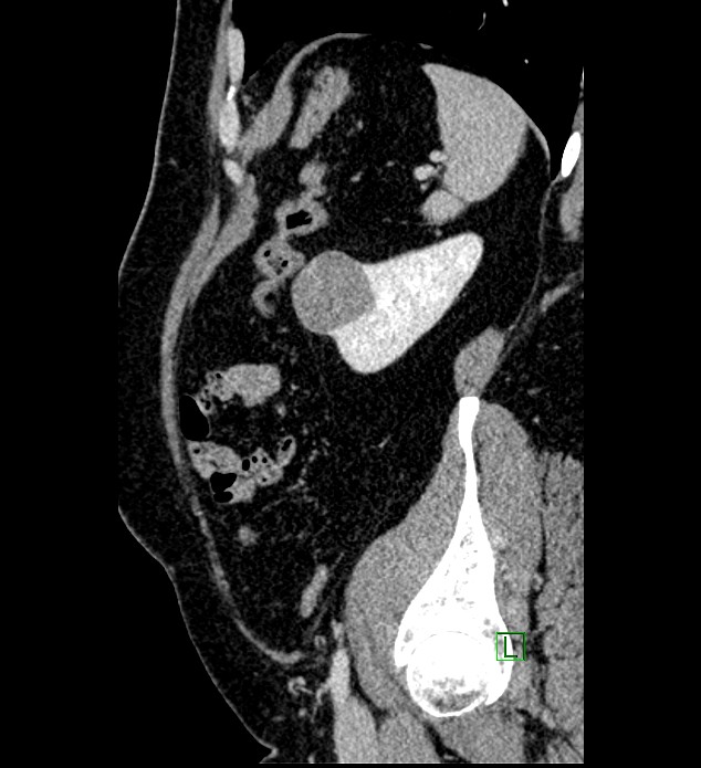 Chromophobe renal cell carcinoma (Radiopaedia 84286-99573 I 39).jpg