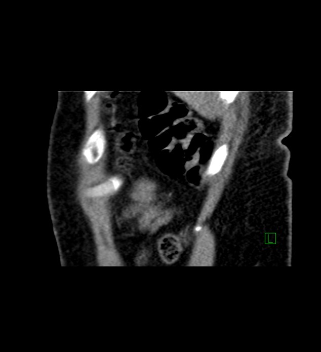 Chromophobe renal cell carcinoma (Radiopaedia 84290-99582 D 7).jpg