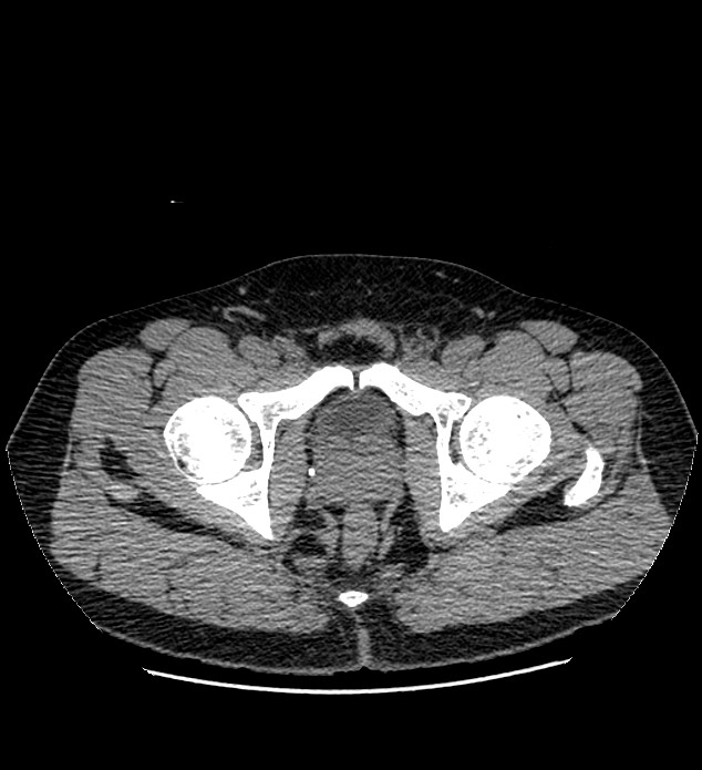 Chromophobe renal cell carcinoma (Radiopaedia 84337-99693 Axial non-contrast 157).jpg