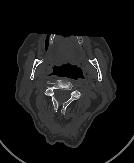 Chronic bilateral subdural hygroma (Radiopaedia 85801-101623 Axial bone window 130).jpg