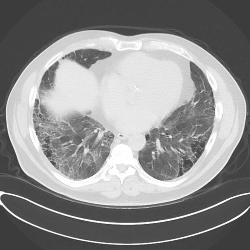 File:Chronic hypersensitivity pneumonitis (Radiopaedia 48107-52922 Axial lung window 40).png