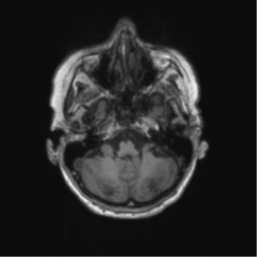 File:Chronic hypertensive encephalopathy (Radiopaedia 72844-83495 Axial T1 58).png
