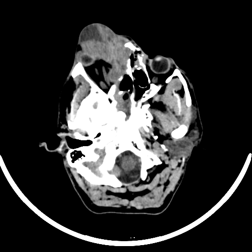 File:Chronic invasive fungal sinusitis with intraorbital and intracranial extension (Radiopaedia 56387-63046 Axial non-contrast 103).jpg