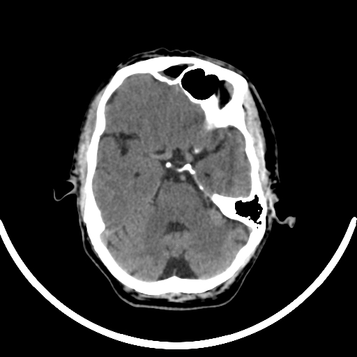 Chronic invasive fungal sinusitis with intraorbital and intracranial extension (Radiopaedia 56387-63046 Axial non-contrast 150).jpg