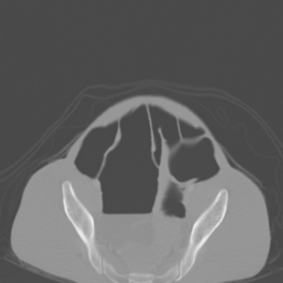 Chronic large bowel pseudo-obstruction (Radiopaedia 43181-46492 Axial bone window 142).jpg