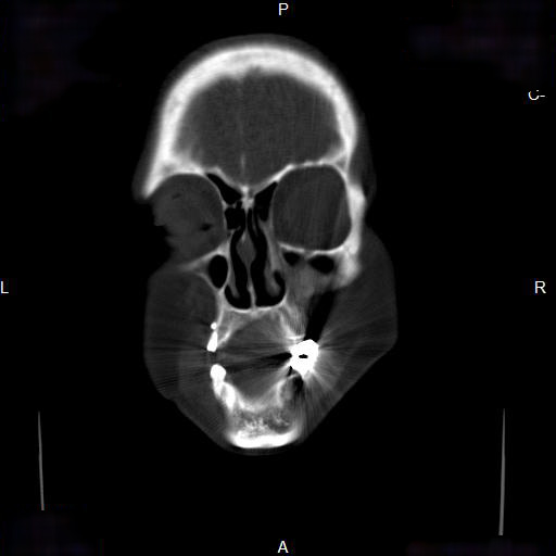 File:Chronic maxillary sinusitis with a foreign body (dental filling material) (Radiopaedia 7811-8639 Coronal bone window 3).jpg