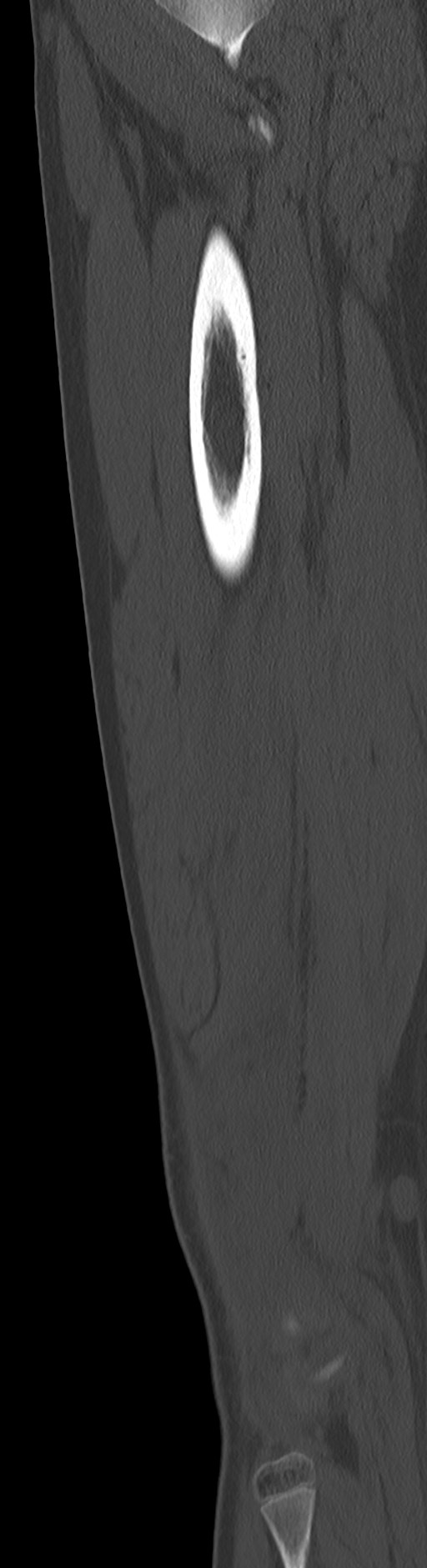 Chronic ostemyelitis of the femur with long sinus tract (Radiopaedia 74947-85982 Sagittal bone window 36).jpg