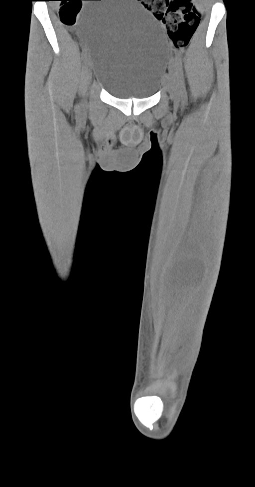 Chronic osteomyelitis (with sequestrum) (Radiopaedia 74813-85822 E 11).jpg