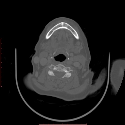 Chronic osteomyelitis - maxilla (Radiopaedia 23783-23927 Axial bone window 15).jpg