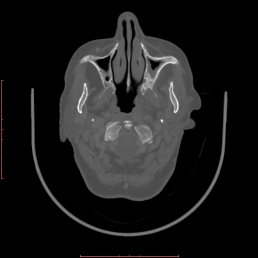 Chronic osteomyelitis - maxilla (Radiopaedia 23783-23927 Axial bone window 97).jpg
