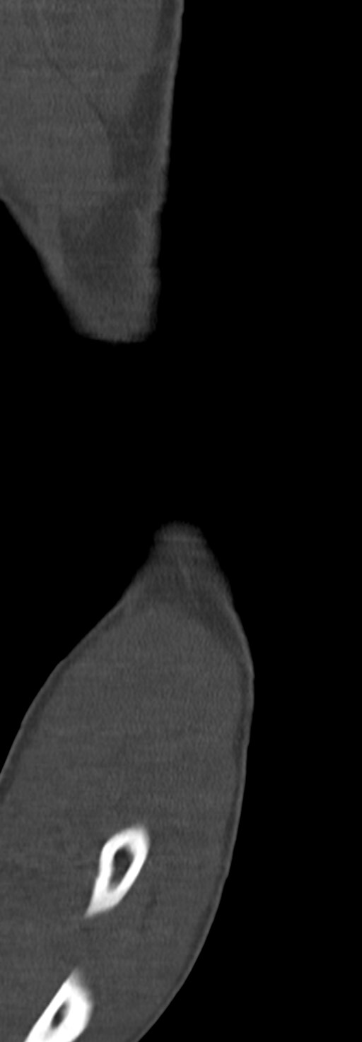Chronic osteomyelitis of the distal humerus (Radiopaedia 78351-90971 Sagittal bone window 28).jpg