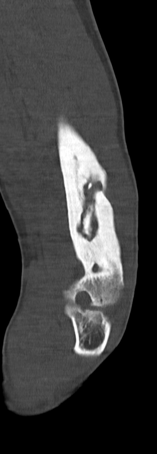 Chronic osteomyelitis of the distal humerus (Radiopaedia 78351-90971 Sagittal bone window 52).jpg