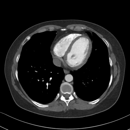 Chronic pulmonary embolus (Radiopaedia 39129-41341 Axial C+ CTPA 72).png