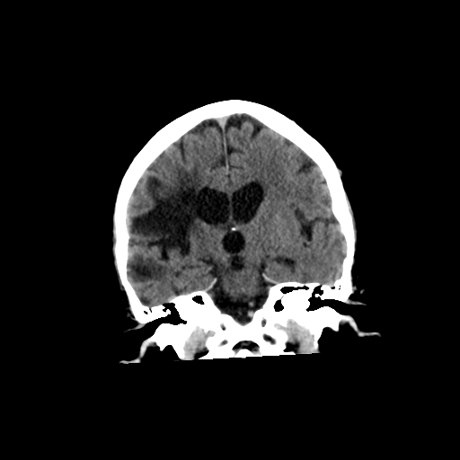 File:Chronic right middle cerebral artery territory infarct (Radiopaedia 39312).png