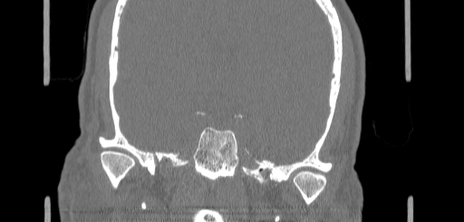 Chronic sphenoidal sinusitis (Radiopaedia 62030-70122 Coronal bone window 146).jpg