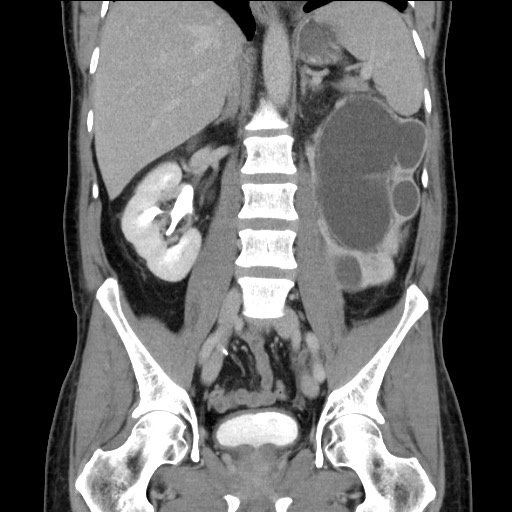 Chronic ureteropelvic junction obstruction (Radiopaedia 78365-90996 B 58).jpg