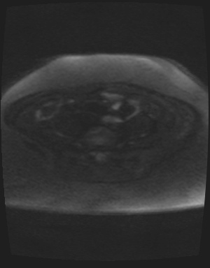 File:Class II Mullerian duct anomaly- unicornuate uterus with rudimentary horn and non-communicating cavity (Radiopaedia 39441-41755 Axial DWI 66).jpg