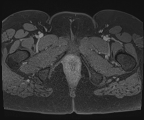 File:Class II Mullerian duct anomaly- unicornuate uterus with rudimentary horn and non-communicating cavity (Radiopaedia 39441-41755 Axial T1 fat sat 142).jpg