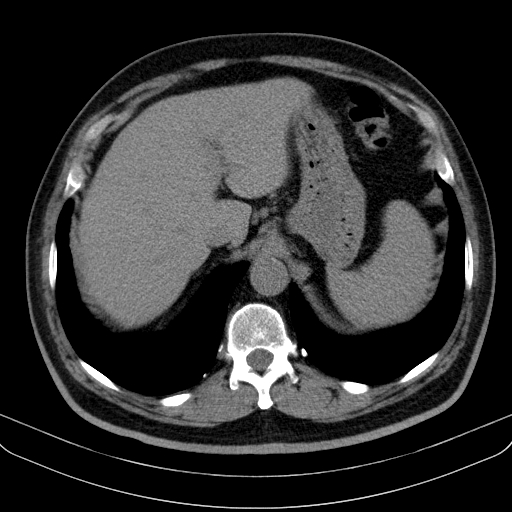 Classic complicated silicosis (Radiopaedia 49720-54961 Axial liver window 51).jpg