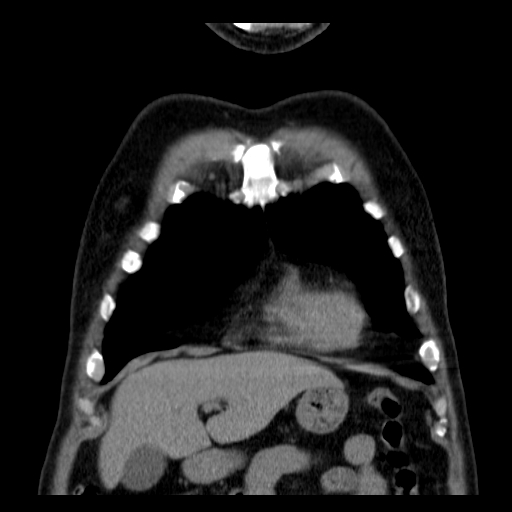 File:Classic complicated silicosis (Radiopaedia 49720-54961 Coronal liver window 7).jpg