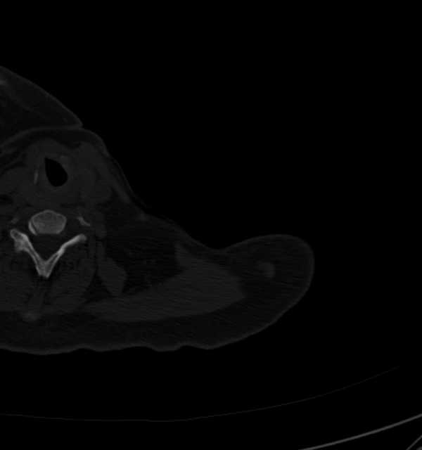 Clear cell chondrosarcoma - humerus (Radiopaedia 63104-71612 Axial bone window 2).jpg