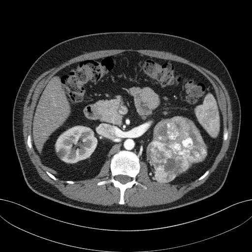 File:Clear cell renal cell carcinoma (Radiopaedia 61449-69393 B 30).jpg