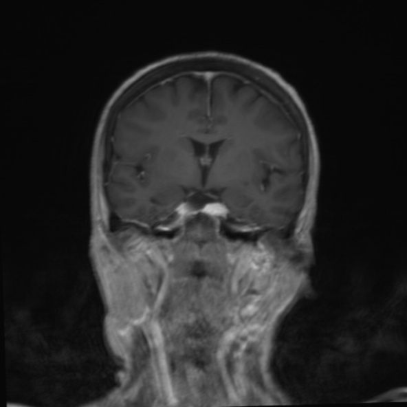 File:Clival meningioma (Radiopaedia 53278-59248 F 14).jpg