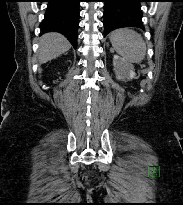 Closed-loop small bowel obstruction-internal hernia (Radiopaedia 78439-91096 Coronal non-contrast 82).jpg
