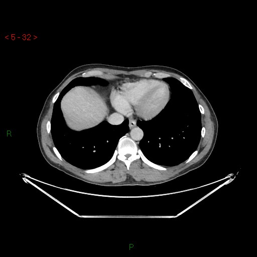 File:Closed loop obstruction and appendicular stump mucocele (Radiopaedia 54014-61158 A 6).jpg