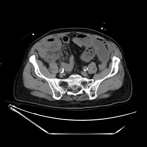 File:Closed loop obstruction due to adhesive band, resulting in small bowel ischemia and resection (Radiopaedia 83835-99023 Axial non-contrast 112).jpg