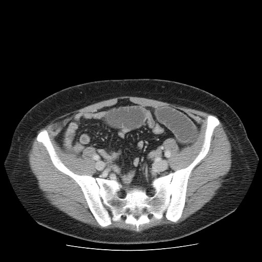 File:Closed loop small bowel obstruction (Radiopaedia 65403-74451 A 61).jpg