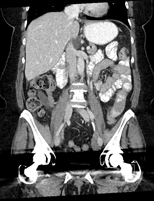 Closed loop small bowel obstruction - adhesions (Radiopaedia 59078-66369 B 63).jpg