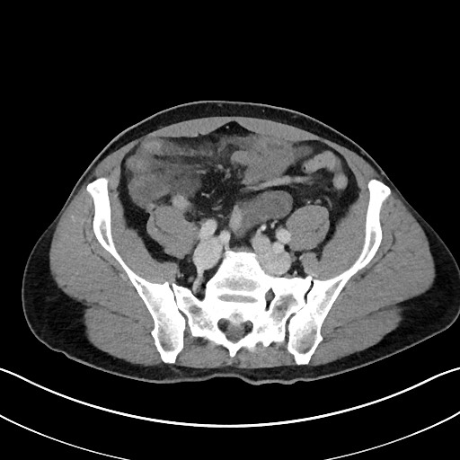Closed loop small bowel obstruction - internal hernia (Radiopaedia 57806-64778 B 92).jpg