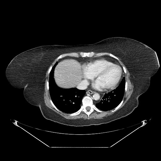 Closed loop small bowel obstruction - internal hernia (Radiopaedia 65402-74450 A 2).jpg