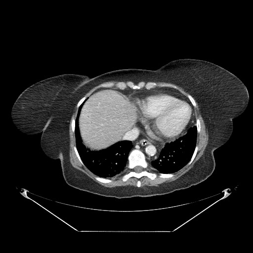 Closed loop small bowel obstruction - internal hernia (Radiopaedia 65402-74450 A 6).jpg