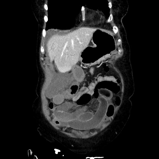 File:Closed loop small bowel obstruction due to adhesive band, with intramural hemorrhage and ischemia (Radiopaedia 83831-99017 C 31).jpg