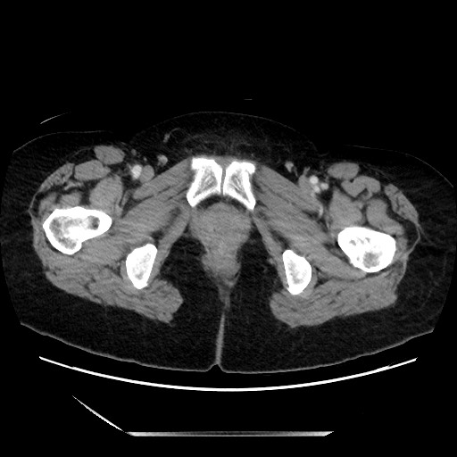 File:Closed loop small bowel obstruction due to adhesive bands - early and late images (Radiopaedia 83830-99014 A 162).jpg
