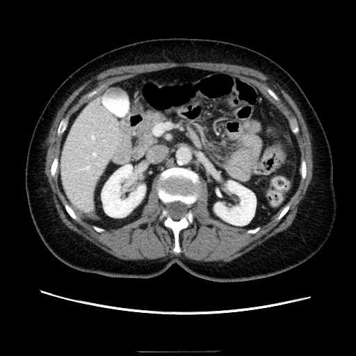 Closed loop small bowel obstruction due to adhesive bands - early and late images (Radiopaedia 83830-99015 A 57).jpg