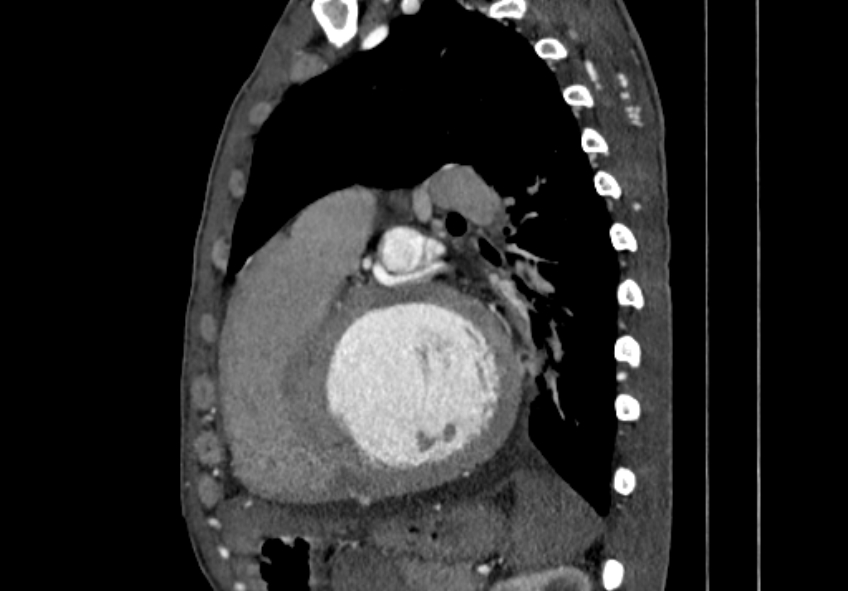 Coarctation of aorta with aortic valve stenosis (Radiopaedia 70463-80574 B 117).jpg