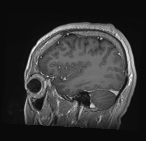 Cochlear incomplete partition type III associated with hypothalamic hamartoma (Radiopaedia 88756-105498 Sagittal T1 C+ 41).jpg