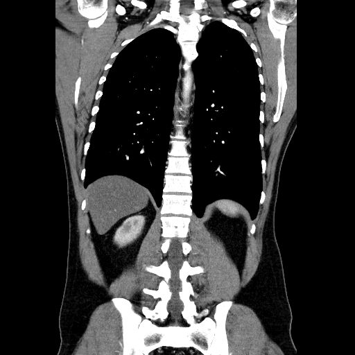 File:Codominant double aortic arch (Radiopaedia 56012-62637 B 34).jpg