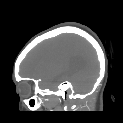 File:Colloid cyst (resulting in death) (Radiopaedia 33423-34499 B 42).png
