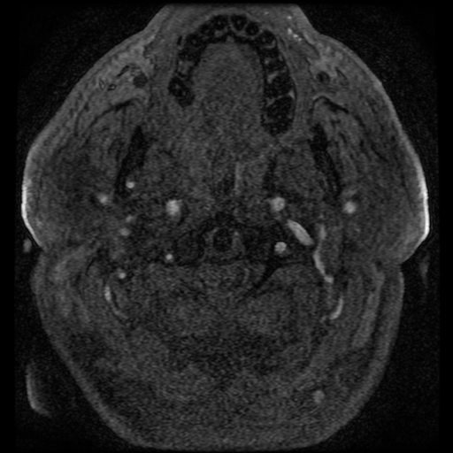 File:Colloid cyst with anterior communicating artery aneurysm (Radiopaedia 33901-35091 Axial MRA 6).jpg