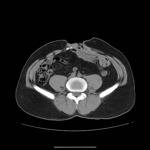 File:Colocutaneous fistula in Crohn's disease (Radiopaedia 29586-30093 Axial non-contrast 18).jpg