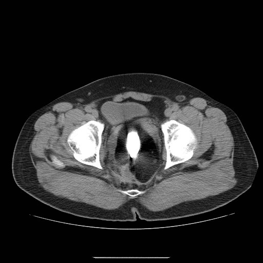 File:Colocutaneous fistula in Crohn's disease (Radiopaedia 29586-30093 D 35).jpg
