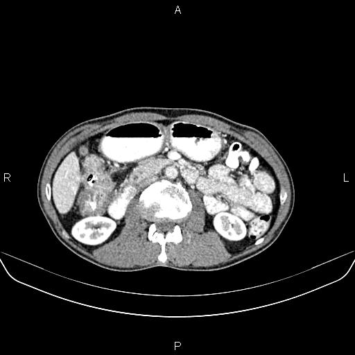 Colon adenocarcinoma - hepatic flexure (Radiopaedia 85635-101395 A 39).jpg