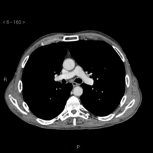 Colonic cancer (ultrasound and TC imaging) (Radiopaedia 50346-55713 B 160).jpg