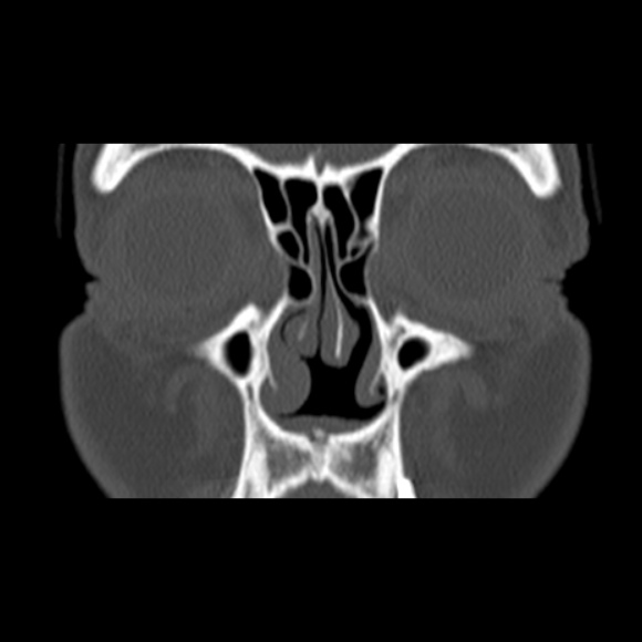 File:Nasal septal perforation (Radiopaedia 25030-25289 Coronal bone window 20).jpg
