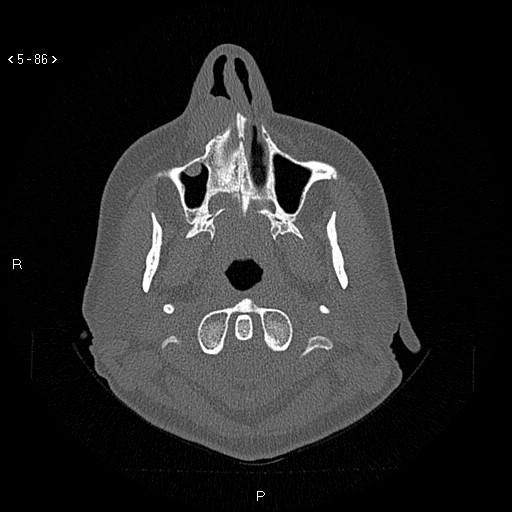 File:Nasolabial cyst (Radiopaedia 75125-86194 Axial bone window 47).jpg