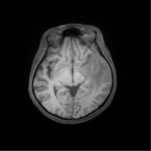 File:Nasopharyngeal carcinoma with cerebral abscess (Radiopaedia 43018-46274 Axial T1 fat sat 25).png
